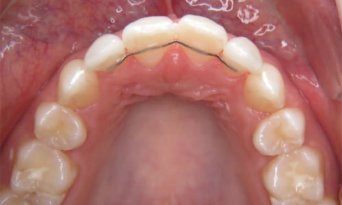Bolton-Diskrepanz-Schneidezaehne-mit-Retainer
