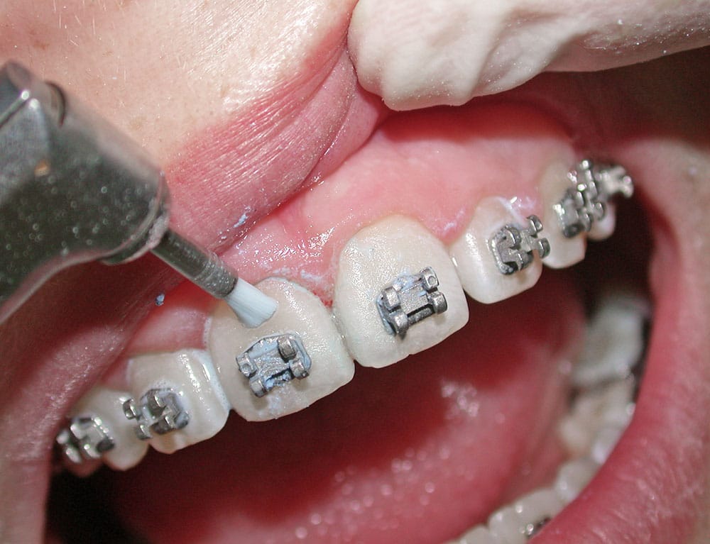 Mundhygiene-Sitzung-Zahnspange